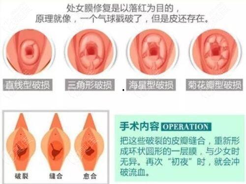 处膜修复手术视频,技术要点与术后护理