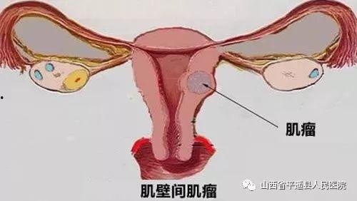 子宫肌瘤手术视频直播