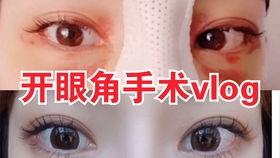 开眼角手术视频过程,专业视角下的美丽蜕变